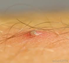 An ingrown hair looks very similar to a pimple — the ingrown hair is often covered by a red bump, and there can white pus visible below the surface. How Do I Treat An Infected Hair Follicle With Pictures