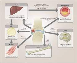 Extra Articular Involvement Rheumatoid Arthritis Google Search Immunology Rheumatoid Arthritis Arthritis