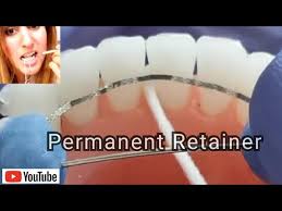 Permanent retainers serve to keep your teeth straight after having braces. How To Clean Permanent Retainers Tips Easy Tricks Youtube