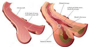 Cystic fibrosis can be treated with airway clearance, antibiotics, mucolytics, lung transplant, and a promising new class of drugs known as cftr modulators. What Is Cystic Fibrosis And Its Significance Medicalnigeria Com For Medical And Healthcare Professionals