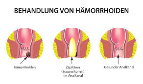 Wir erklären, wie viel blutverlust normal ist, und wann sie bei stark blutenden hämorrhoiden zum arzt gehen sollten. Welche Salben Oder Cremes Helfen Bei Hamorrhoiden