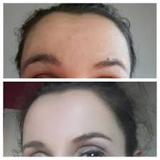 Voor En Na 1 Week Ltr Na Medik8 Lightpeel Huidverzorging