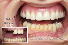 How do you strengthen loose tooth? How To Fix Loose Dental Implants Smile Design Dentistry