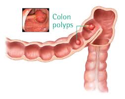 For this reason, doctors recommend regular screening tests to help prevent colon cancer by identifying and removing polyps before they turn into. Colorectal Cancer Colon Cancer Signs Diagnosis Treatment In Singapore Pcc Singapore