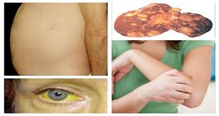 Some patients may have worsening symptoms of chronic liver disease or cirrhosis, which often precedes the development of cancer of the liver. Earliest Warning Signs Of Liver Cancer You Should Never Ignore