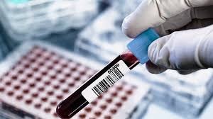 Image result for Rheumatoid Factor