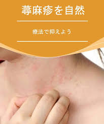 蕁麻疹を自然療法で抑えよう みんな健康 自然療法 蕁麻疹 じんましん