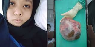 Apa tanda2 cyst, dan apa tindakan saya. Umpama Mengandung 7 Bulan Gadis Ini Kongsi Derita Menanggung Cyst Seberat 5kg