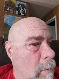 I get grand mals once a year but mostly focal point seizures it messes with  my depth perception. I got my head badly when I was 7 a beam fell