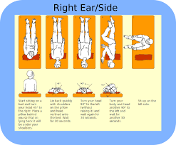 Right Sided Bppv Treatment Epley Maneuver Vertigo Vertigo Treatment