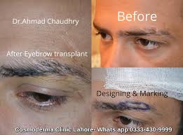 After eyebrow transplant, tiny crusts may appear but they will heal in one week. Eyebrow Hair Transplant Clinic Lahore Pakistan Best Eyebrow Hair Restoration Surgeon