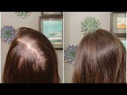 How To Deal With That Crazy Part In The Back Of Your Head Youtube Parting Hair Bobs For Thin Hair Hair Thinning On Top
