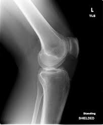 Image result for XRay Changes in Rheumatic Conditions
