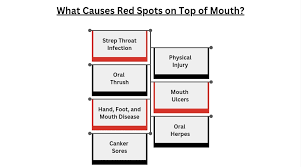 Image result for Physical injury red spots roof of mouth