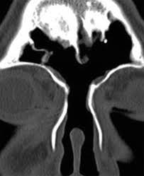 There is a close relation with the optic nerve. The Preoperative Sinus Ct Avoiding A Close Call With Surgical Complications Radiology