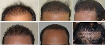 It's worth mentioning that many hair transplant clinics claim that the main benefit of fue treatment is that scars will not be left. Failed Hair Transplant Repair Wrong Hair Transplant Repair