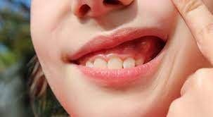Once the abscess spreads to othe. What Is A Parulis Dental Fistula Causes Treatment Suburban Essex
