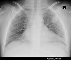 Bilateral lower lobe pneumonia • lateral view confirms lower lobe location. Pneumonia In Children Intechopen