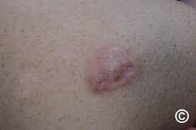 Image result for Leiomyosarcoma