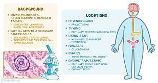 We surveyed women's primary care clinicians to assess how the interval breast cancers were found. Psammoma Bodies What Are They Where They Are Found And More Osmosis