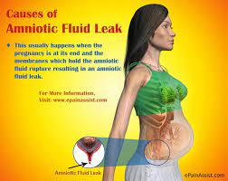 This problem can pose a great risk to both the mother and the baby if not treated or handled in time. Amniotic Fluid Leak Causes Signs Treatment