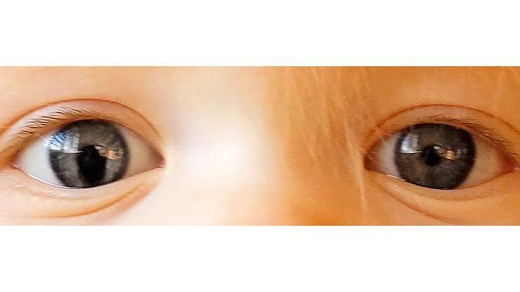 Cat Eye Syndrome: Symptoms, Causes, Treatment, Pictures, More