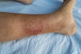 Definitions for sepsis and organ failure and guidelines for the use of innovative therapies in sepsis. Sepsi I Sintomi Le Cause E La Terapia Ohga