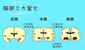 了解阿茲海默症 understanding alzheimer 39 s disease. é˜¿èŒ²æµ·é»˜ç—‡10å¤§ç—‡ç‹€ æ•™ä½ 6æ‹›é é˜²å¤±æ™º Ihealth