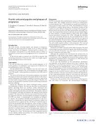 Image result for pruritic urticarial papules and plaques of pregnancy
