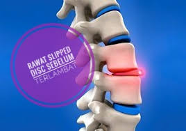 Biasanya ia berlaku kepada bahagian pinggang dan tengkuk. Rawat Slipped Disc Sebelum Terlambat