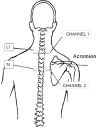 Electrode Placement For Transcutaneous Electrical Nerve