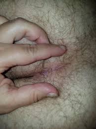 I have a ingrown hair under my tailbone i got the hair out but theres still a lot of pressure it's throbbing and really hurts? answered by dr. So My So Was Complaining Of Swelling And Being Tender At His Tailbone Nsfw Ish Popping