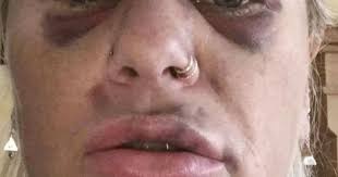 'I was beaten to a pulp by my monster ex then he was freed after 8 weeks  jail'