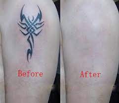 But keep in mind, some colors remove better than others, and multiple treatments are required. Tatto Removal Using Picosecond Laser Salt Lake City Utah