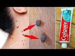 6 Remove Skin Tags In 1 Night 2 Amazing Remedies For Skin Tags Removal How To Remove Skin T Diy Skin Tag Removal Skin Tag Removal Skin Tags Home Remedies