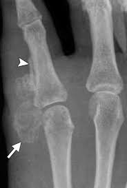 Foot melanoma refers to cancer of the cells in the top layer of the skin on the foot. Diagnostic Imaging Of Benign And Malignant Osseous Tumors Of The Fingers Radiographics