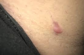 Scalp folliculitis is a skin condition where the hair follicles on the scalp become inflamed or irritated. Ingrown Hair Staph Ingrown Hair