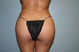 Young's office for your own personalized quote. Brazilian Butt Lift Houston Tx Bbl Surgery Dr Leo Lapuerta