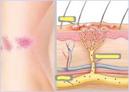 Điều trị sớm Zona thần kinh