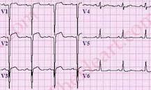 Image result for during the course of an acute mi, when is st elevation initially seen on an ecg