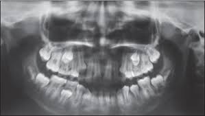 Hard palate cancer begins in the bony part on the roof of the mouth. Osteosarcoma Of Mandible In A 10 Year Old Girl Nirmala S Nuvvula S Kumar K Babu M Chilamakuri S J Indian Soc Pedod Prev Dent