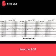 Image result for Non-Stress Test