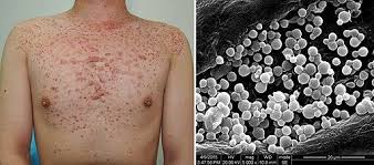Image result for folliculitis symptoms