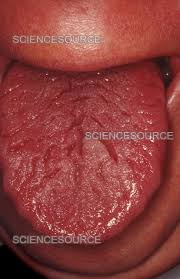 Image result for Fissured tongue