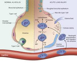 Image result for Pulmonary Intoxicant