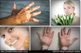 Natural Vitiligo Treatment System Review Reveals Michael Dawson S Simple Vitiligo Cure