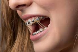 New braces are an exciting path towards your new smile. Do Braces Hurt Perfect Smiles Orthodontics Blog