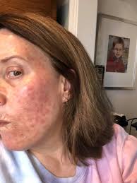 Hello I had my staples out