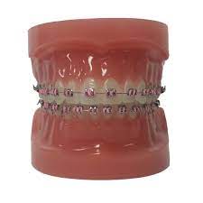 Blue (1) gold (1) pink (1) red (1) shop by price. Braces Colors Marcel Orthodontics
