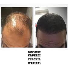 Trapianto di capelli in turchia con tecnica fue: Trapianto Di Capelli Turchia Italia Home Facebook